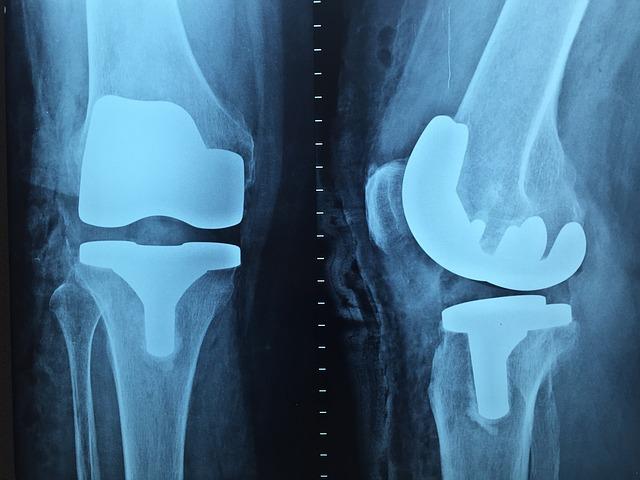 Damages awarded for delay in diagnosing elbow injury